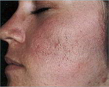 cicatrici acne rimedi